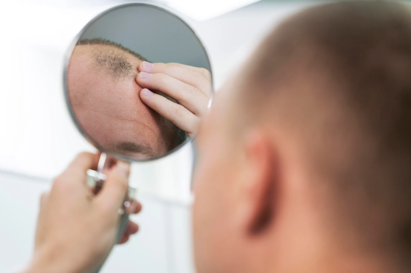 Haartransplantatie en de Invloed van Genetica op Haarverlies