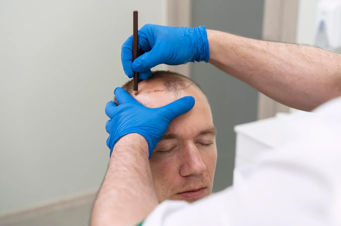 Haartransplantatie in Duiven: De Juiste Voorbereiding voor een Succesvolle Behandeling