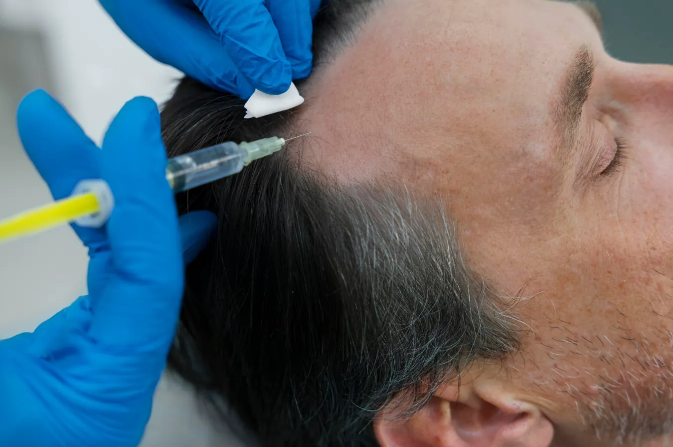De Verbetering van Haartransplantaties in Elst: Patiënten Delen Hun Voor-en-Na Verhalen
