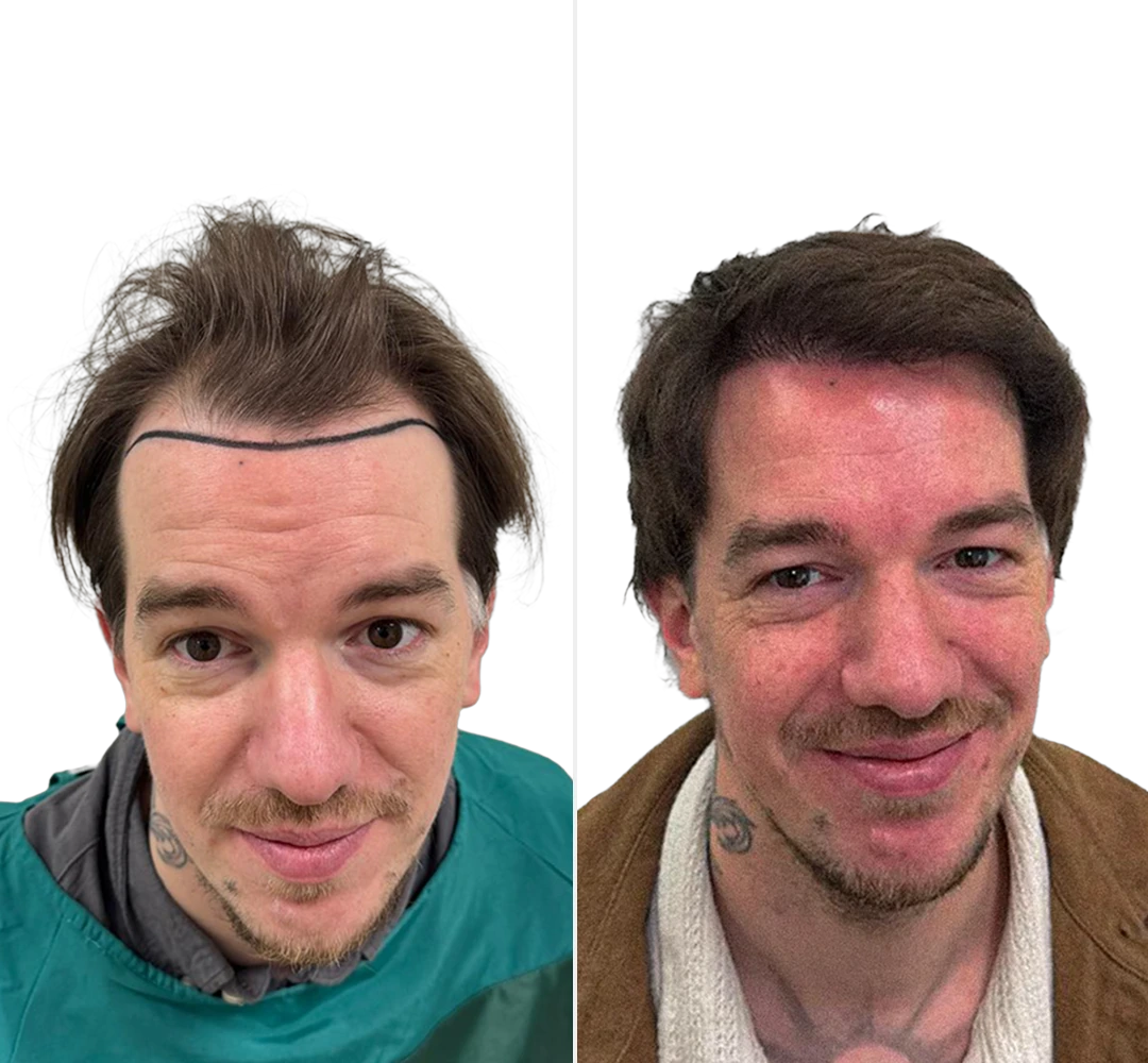 Voor en na resultaat van Jesse - Saffier FUE haartransplantatie