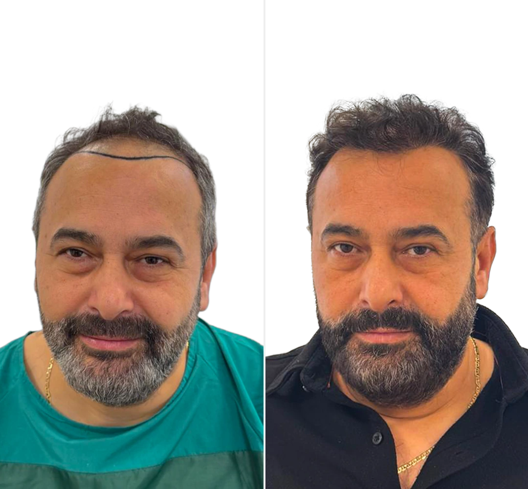 Voor en na resultaat van Halil - Saffier FUE haartransplantatie