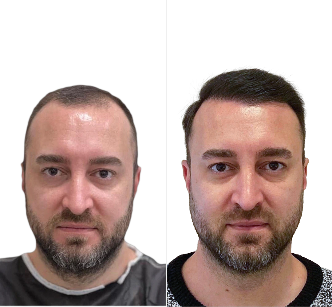 Voor en na resultaat van Arda - Saffier FUE haartransplantatie