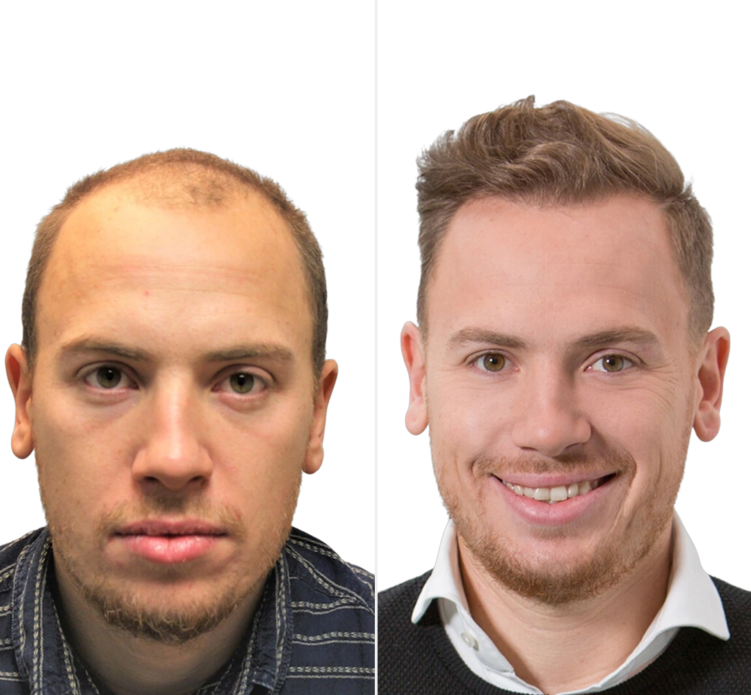 Voor en na resultaat van Lars - DHI haartransplantatie